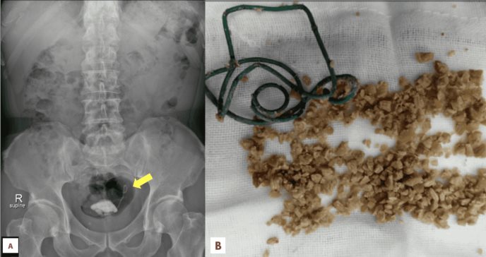 Stent D-J no retirado se convierte en el núcleo de un cálculo vesical causando hidronefrosis