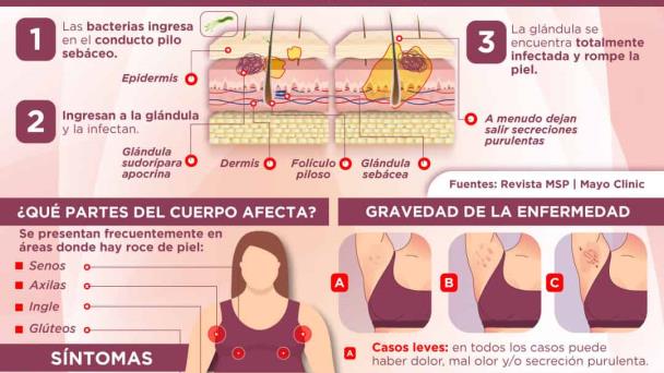 Día mundial de la hidradenitis supurativa | Infografía Día mundial de la hidradenitis supurativa | Infografía