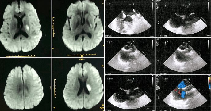 Infarto migrañoso con aura ocasiona parálisis y debilidad muscular en paciente con cefalea recurrente