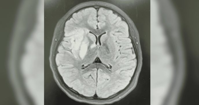 Paciente pediátrica presenta ictus mientras hace senderismo con dolor de cabeza súbito y hemiparesia