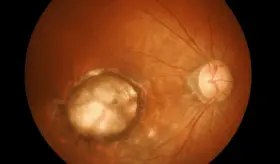 Fumar desencadenar&iacute;a problemas graves en ojos y visi&oacute;n, como la degeneraci&oacute;n macular y ojo seco
