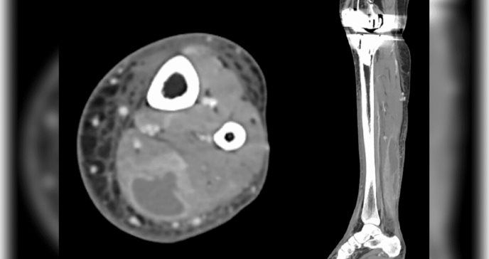 Paciente presenta absceso intramuscular de Bacteroides pyogenes tras ser mordida por su gato