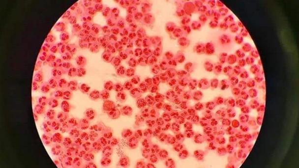 Primer antibiótico oral desarrollado para tratar infecciones por gonorrea resistente en una dosis Primer antibiótico oral desarrollado para tratar infecciones por gonorrea resistente en una dosis