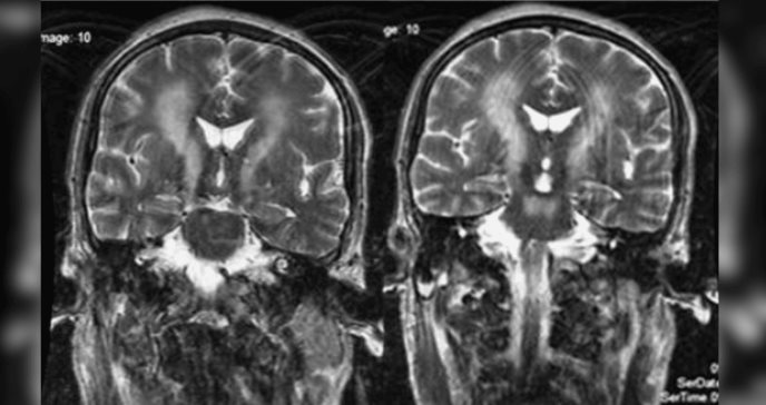 Detectan “signo de copa” en paciente con esclerosis lateral primaria y afectación en vía corticoespinal