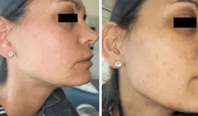 Ibuprofeno en altas dosis provoca grave reacción alérgica en una paciente de 45 años