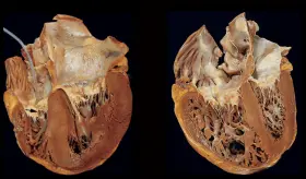 Cor pulmonale: el trastorno cardíaco por engrosamiento relacionado con las enfermedades pulmonares