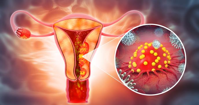 Análisis de sangre podría detectar el cáncer de ovario hasta cuatro años antes