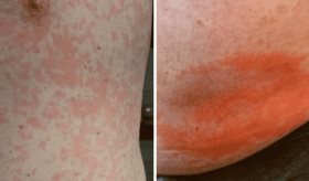 Reportan caso de síndrome de Schnitzler incompleto en paciente con ocho años de urticaria recurrente