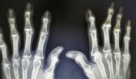 Exposición a dioxinas y policlorobifenilos no aumentan el riesgo de artritis reumatoide en mujeres