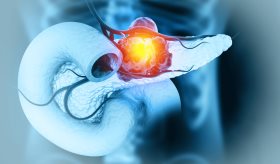 PGLYRP1: La proteína que permite al cáncer de páncreas evadir el sistema inmunitario