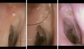 Reportan raro crecimiento de vello endotraqueal en paciente con antecedentes de tabaquismo