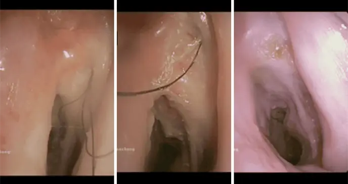 Reportan raro crecimiento de vello endotraqueal en paciente con antecedentes de tabaquismo Reportan raro crecimiento de vello endotraqueal en paciente con antecedentes de tabaquismo