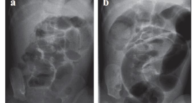 Invaginación Intestinal: ¿Qué puede causar el pliegue de una parte del intestino dentro de sí mismo? 