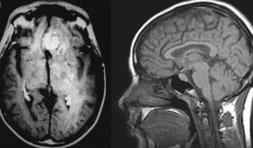 Por primera vez se probarían medicamentos contra el VIH como tratamiento para tumores cerebrales