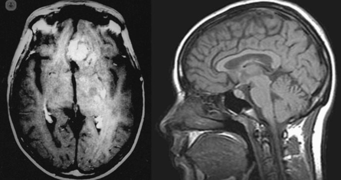 Por primera vez se probarían medicamentos contra el VIH como tratamiento para tumores cerebrales