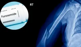 Consumo de diuréticos como furosemida se asocia con mayor riesgo de fracturas óseas por efecto adverso