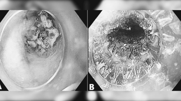 Paciente con cáncer de esófago desarrolla fibrilación auricular tras colocación de un stent esofágico Paciente con cáncer de esófago desarrolla fibrilación auricular tras colocación de un stent esofágico