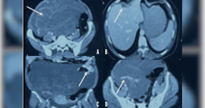 Reportan inusual hallazgo de pseudomixoma peritoneal o “barriga gelatinosa” por tumor ovárico
