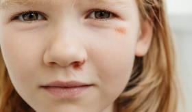 Maltrato infantil podría afectar la salud en la adultez generando obesidad y problemas en sistema inmune