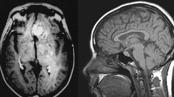 Los tumores cerebrales en niños con neurofibromatosis podrían prevenirse con fármaco para la epilepsia Los tumores cerebrales en niños con neurofibromatosis podrían prevenirse con fármaco para la epilepsia