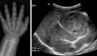 Vello púbico y comportamiento violento en una niña de un año por tumor que produce exceso hormonal