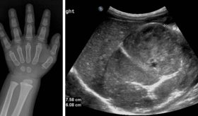 Vello púbico y comportamiento violento en una niña de un año por tumor que produce exceso hormonal