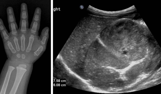 Vello púbico y comportamiento violento en una niña de un año por tumor que produce exceso hormonal