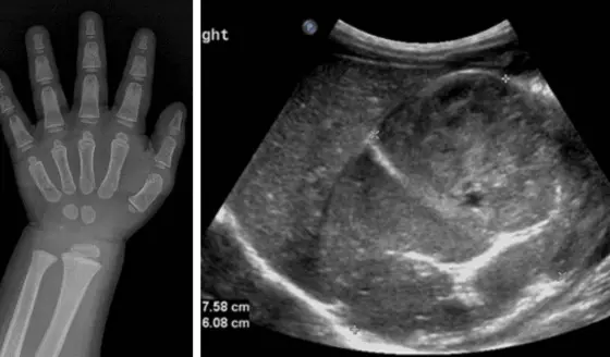 Vello púbico y comportamiento violento en una niña de un año por tumor que produce exceso hormonal