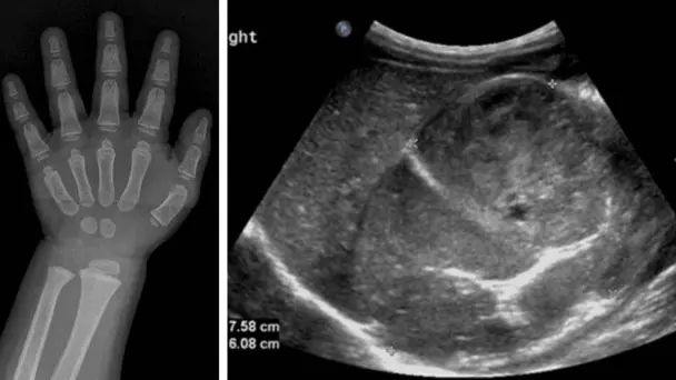 Vello púbico y comportamiento violento en una niña de un año por tumor que produce exceso hormonal Vello púbico y comportamiento violento en una niña de un año por tumor que produce exceso hormonal