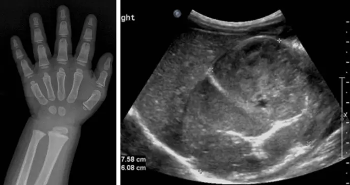 Vello púbico y comportamiento violento en una niña de un año por tumor que produce exceso hormonal