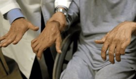 Artritis Reumatoide: diagnóstico, tratamiento y vínculo con la morbilidad por enfermedad cardiovascular
