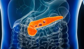 Terapia dirigida mejora significativamente la supervivencia en pacientes con cáncer pancreático avanzado