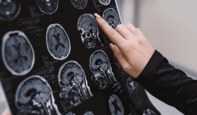 El tratamiento con dopamina aliviaría los síntomas del alzhéimer, según estudio