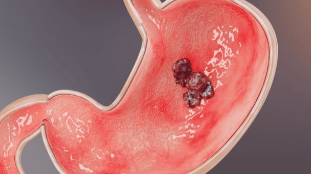 Mini-examen clínico: ¿Puede identificar, diagnosticar y tratar el cáncer gástrico HER2 positivo? Mini-examen clínico: ¿Puede identificar, diagnosticar y tratar el cáncer gástrico HER2 positivo?