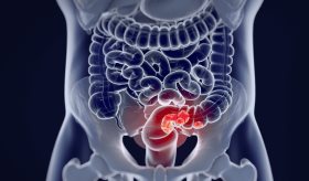 Análisis genético del cáncer colorrectal revela mutación asociada al tabaquismo y al consumo de alcohol