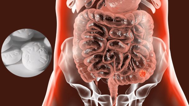 La aspirina reduce el riesgo de cáncer colorrectal en personas con factores de riesgo elevados: estudio La aspirina reduce el riesgo de cáncer colorrectal en personas con factores de riesgo elevados: estudio