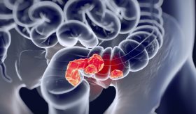 Alteración mecánica en las células del cáncer colorrectal podría evitar el proceso metastásico