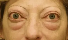 &iquest;Qu&eacute; es la oftalmopat&iacute;a tiroidea y por qu&eacute; est&aacute; ligada al hipertiroidismo?