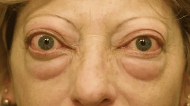 ¿Qué es la oftalmopatía tiroidea y por qué está ligada al hipertiroidismo? ¿Qué es la oftalmopatía tiroidea y por qué está ligada al hipertiroidismo?
