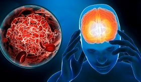 Migrañas, strokes y demencia son las afecciones neurológicas más comunes, según estudio