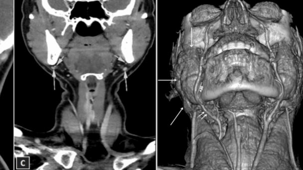 Detectan ausencia bilateral de glándulas submandibulares en seguimiento por nódulo tiroideo Detectan ausencia bilateral de glándulas submandibulares en seguimiento por nódulo tiroideo