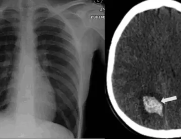 Paciente sufre hemorragia transcraneal como manifestación extrapulmonar de COVID-19
