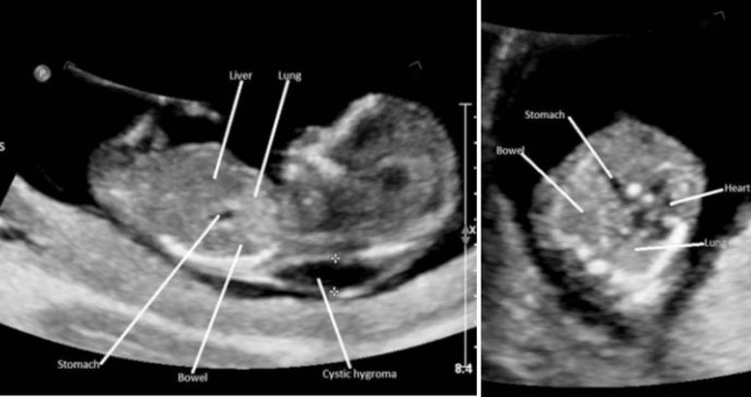 Neonato con higroma quístico y corazón desplazado es diagnosticado con hernia diafragmática congénita