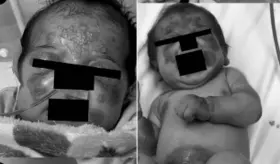 Niña de 3 años con fiebre recurrente y erupciones cutáneas es diagnosticada con Hipergammaglobulinemia D