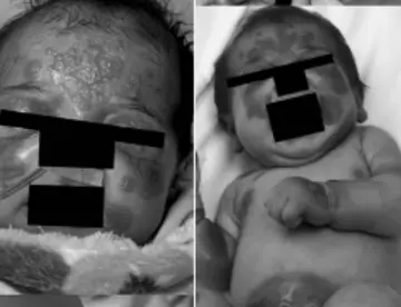 Niña de 3 años con fiebre recurrente y erupciones cutáneas es diagnosticada con Hipergammaglobulinemia D