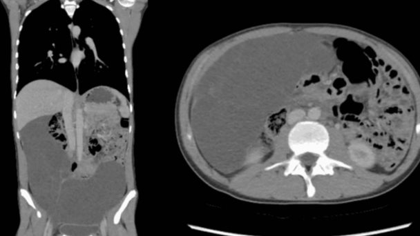 Mesotelioma peritoneal multiquístico benigno en un adolescente: caso extremadamente raro en varones Mesotelioma peritoneal multiquístico benigno en un adolescente: caso extremadamente raro en varones