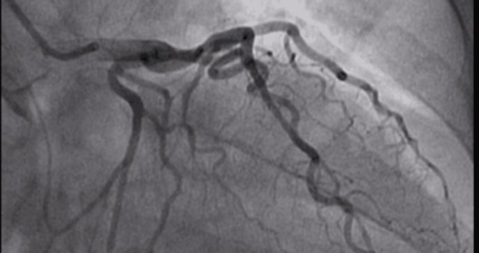 Identifican posible causa de la displasia fibromuscular asociada a la alteración del gen UBR4