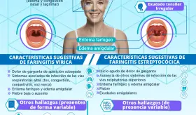 Faringitis vírica VS faringitis estreptocócica | Infografía