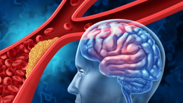 Accidentes cerebrovasculares han aumentado un 70% desde 1990, alcanzando 7,3 millones de muertes anuales Accidentes cerebrovasculares han aumentado un 70% desde 1990, alcanzando 7,3 millones de muertes anuales