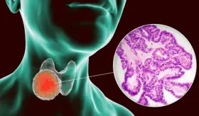Expertos aseguran que las lesiones en la tiroides en estadios iniciales se cura en un 95% de lo casos